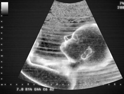 7 Week Ultrasound